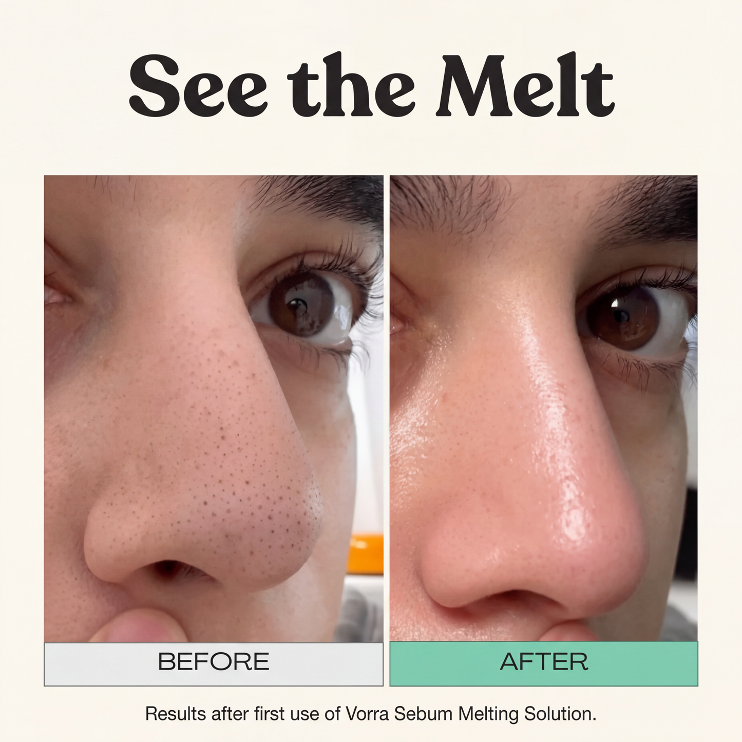 Vorra™ Sebum Melting Pore Kit