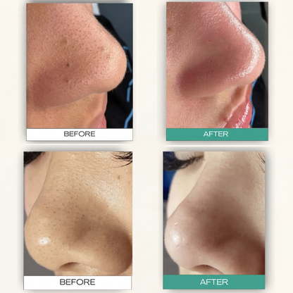 Vorra™ Sebum Melting Pore Kit